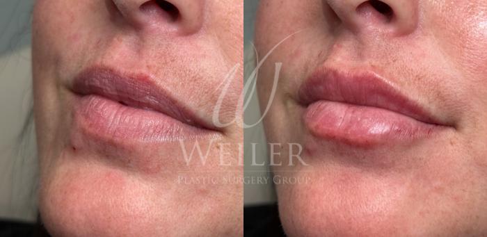 Before & After JUVÉDERM® Case 1743 Left Side View in Baton Rouge, New Orleans, & Lafayette, Louisiana