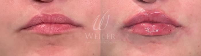 Before & After JUVÉDERM® Case 1746 Front View in Baton Rouge, New Orleans, & Lafayette, Louisiana