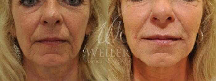 Before & After JUVÉDERM® Case 610 Front View in Baton Rouge, New Orleans, & Lafayette, Louisiana