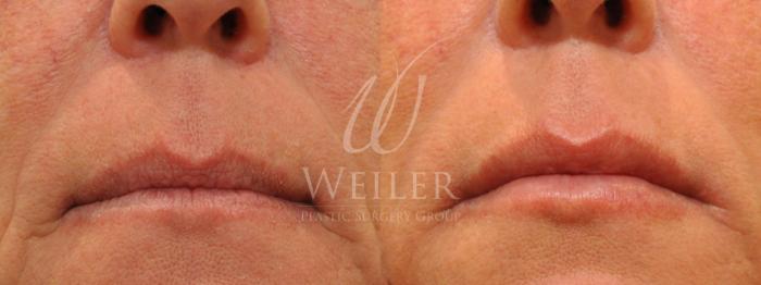 Before & After Lip Augmentation Case 611 Front View in Baton Rouge, New Orleans, & Lafayette, Louisiana