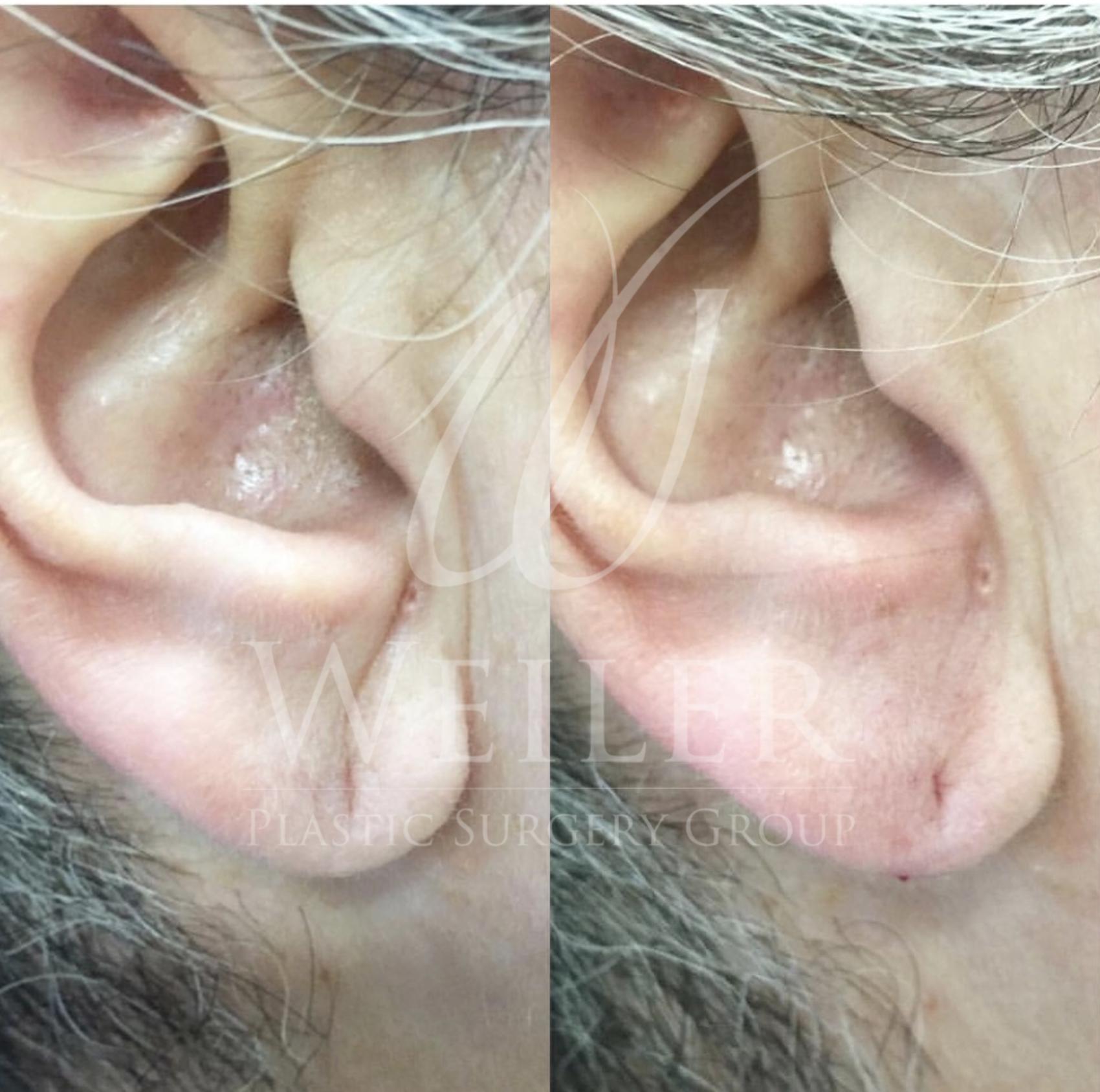 Before & After JUVÉDERM® Case 614 Right Side View in Baton Rouge, Louisiana