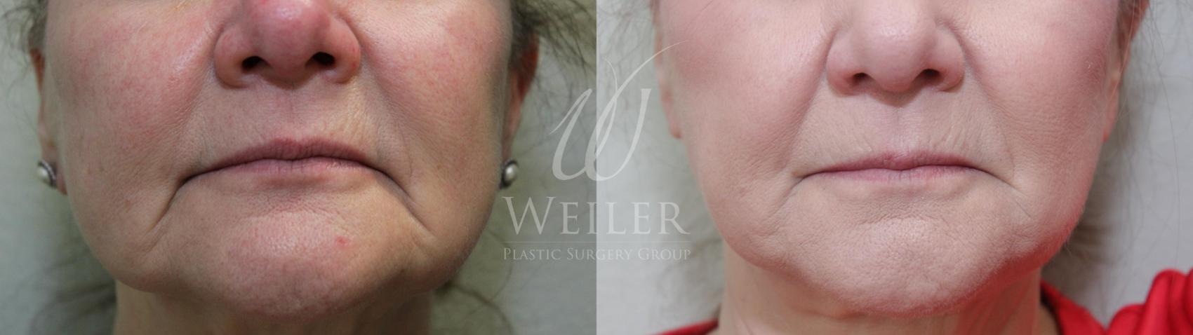 Before & After JUVÉDERM® Case 625 Front View in Baton Rouge, Louisiana