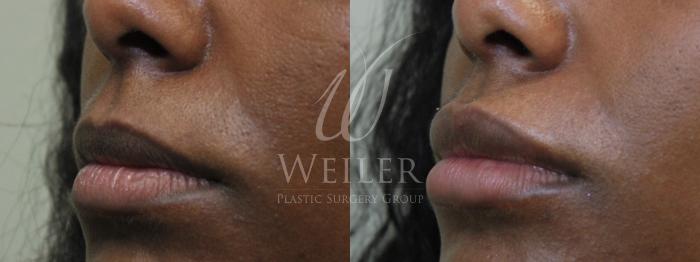 Before & After Lip Augmentation Case 630 Left Oblique View in Baton Rouge, Louisiana