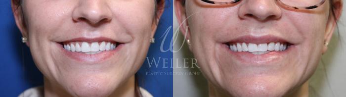 Before & After JUVÉDERM® Case 702 Front  View in Baton Rouge, New Orleans, & Lafayette, Louisiana