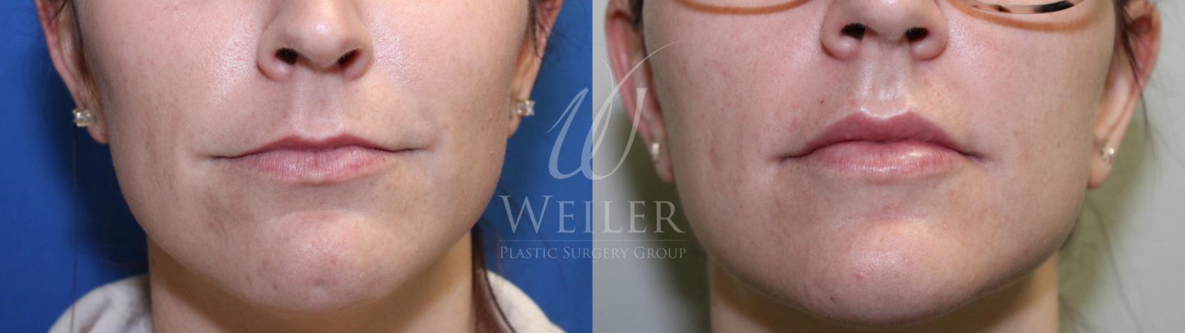 Before & After JUVÉDERM® Case 702 Front View in Baton Rouge, New Orleans, & Lafayette, Louisiana