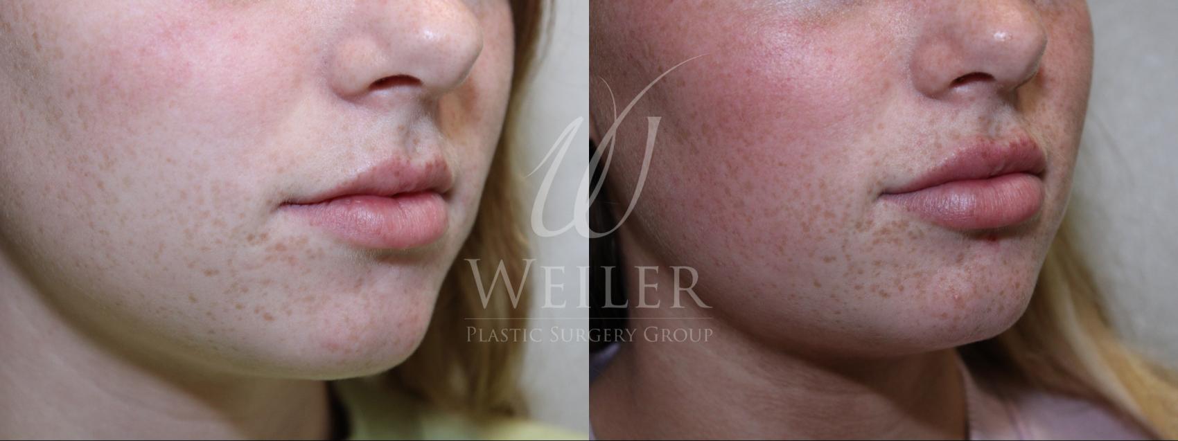 Before & After JUVÉDERM® Case 787 Right Oblique View in Baton Rouge, Louisiana