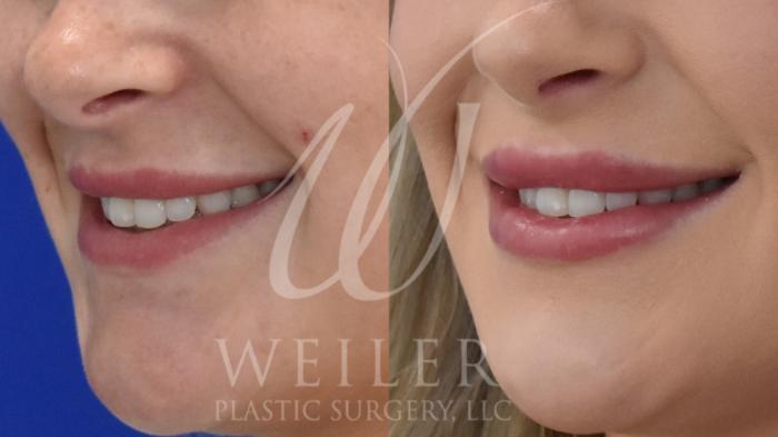 Before & After Lip Augmentation Case 913 Left Side View in Baton Rouge, New Orleans, & Lafayette, Louisiana
