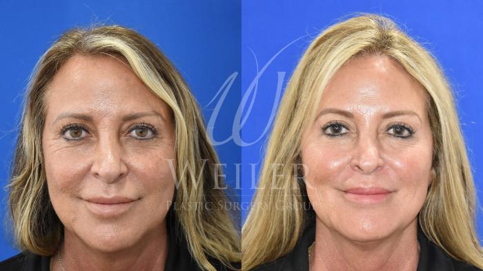 Before & After JUVÉDERM® Case 982 Front View in Baton Rouge, Louisiana