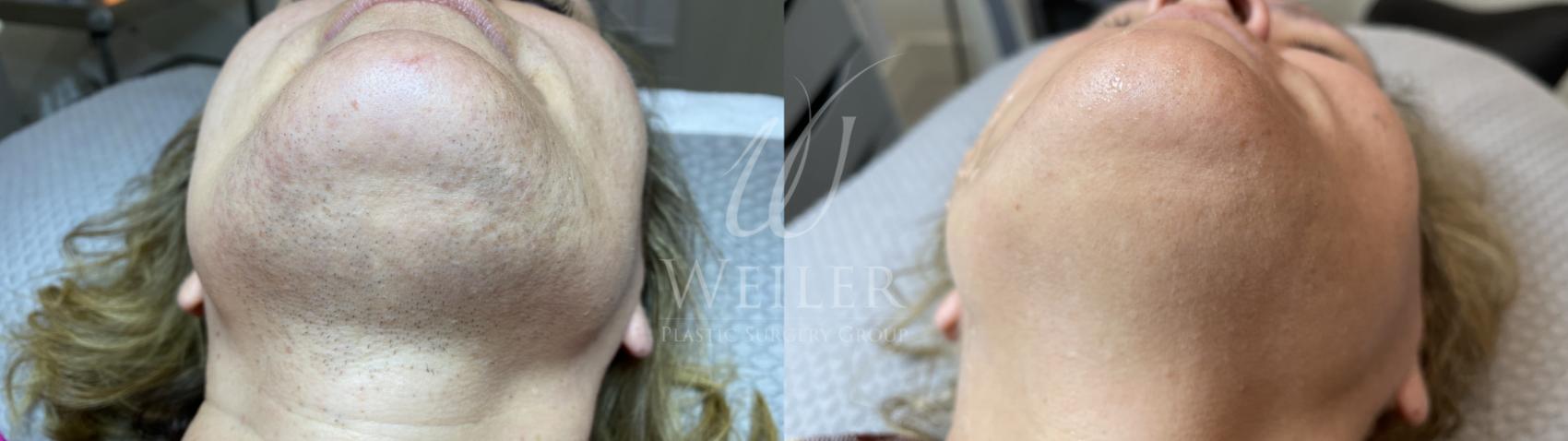 Before & After Laser Hair Removal Case 1432 Front View in Baton Rouge, New Orleans, & Lafayette, Louisiana