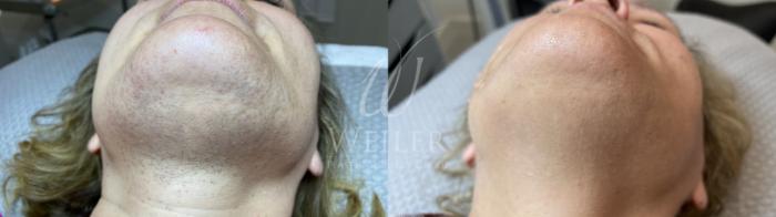 Before & After Laser Hair Removal Case 1432 Front View in Baton Rouge, New Orleans, & Lafayette, Louisiana