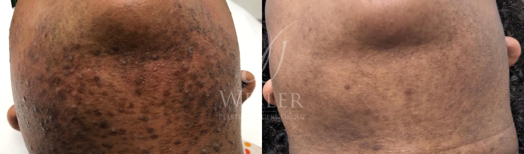 Before & After Laser Hair Removal Case 1555 Front View in Baton Rouge, New Orleans, & Lafayette, Louisiana