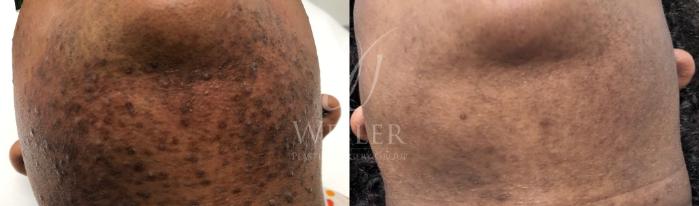Before & After Laser Hair Removal Case 1555 Front View in Baton Rouge, New Orleans, & Lafayette, Louisiana