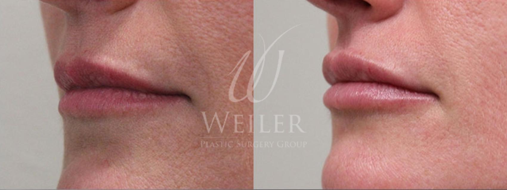 Before & After Lip Augmentation Case 10 View #1 View in Baton Rouge, Louisiana