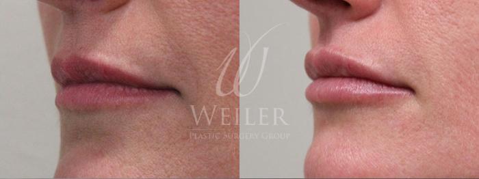 Before & After Lip Augmentation Case 10 View #1 View in Baton Rouge, New Orleans, & Lafayette, Louisiana