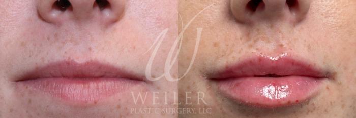 Before & After Lip Augmentation Case 1043 Front View in Baton Rouge, Louisiana