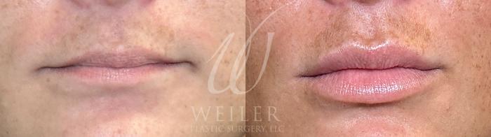 Before & After JUVÉDERM® Case 1096 Front View in Baton Rouge, Louisiana