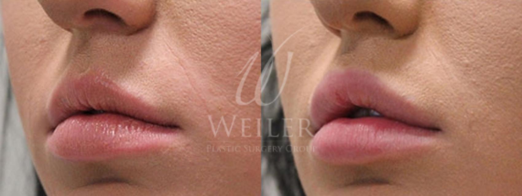 Before & After Lip Augmentation Case 11 View #1 View in Baton Rouge, New Orleans, & Lafayette, Louisiana