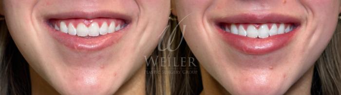Before & After Lip Augmentation Case 1146 Front View in Baton Rouge, Louisiana