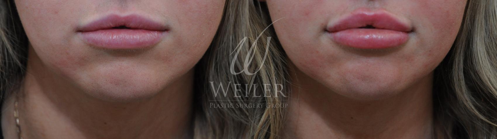 Before & After Lip Augmentation Case 1148 Front View in Baton Rouge, Louisiana