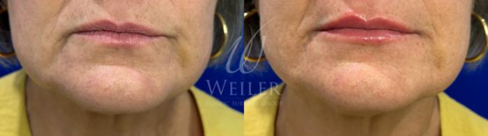 Before & After Lip Augmentation Case 1152 Front View in Baton Rouge, New Orleans, & Lafayette, Louisiana