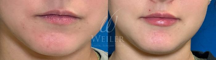 Before & After Lip Augmentation Case 1154 Front View in Baton Rouge, New Orleans, & Lafayette, Louisiana