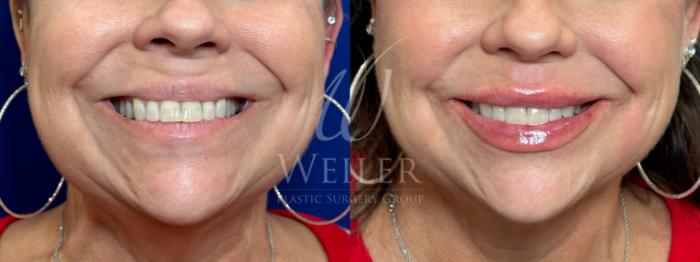 Before & After Lip Augmentation Case 1155 Front View in Baton Rouge, New Orleans, & Lafayette, Louisiana