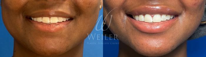 Before & After Lip Augmentation Case 1156 Front View in Baton Rouge, Louisiana