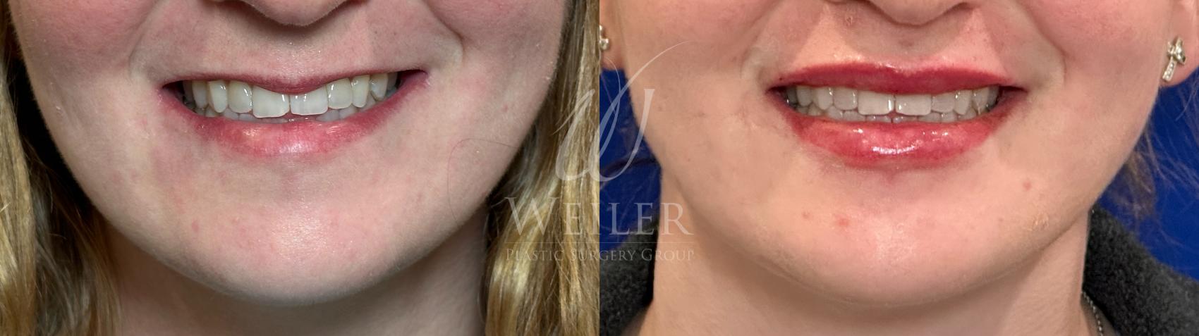 Before & After Lip Augmentation Case 1158 Front View in Baton Rouge, New Orleans, & Lafayette, Louisiana