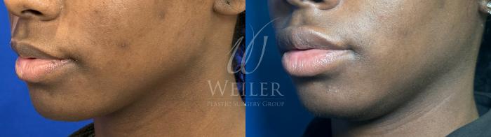 Before & After Lip Augmentation Case 1183 Left Side View in Baton Rouge, New Orleans, & Lafayette, Louisiana