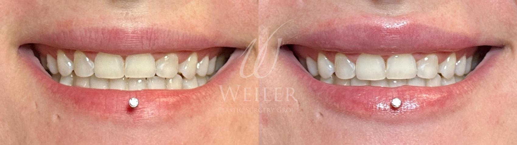 Before & After Lip Augmentation Case 1198 Front View in Baton Rouge, New Orleans, & Lafayette, Louisiana