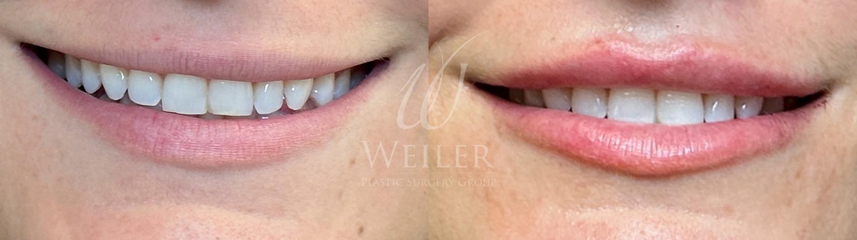 Before & After Lip Augmentation Case 1200 Front View in Baton Rouge, New Orleans, & Lafayette, Louisiana
