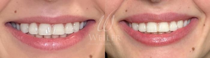 Before & After Lip Augmentation Case 1204 Front View in Baton Rouge, New Orleans, & Lafayette, Louisiana