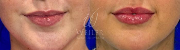 Before & After Lip Augmentation Case 1205 Front View in Baton Rouge, New Orleans, & Lafayette, Louisiana