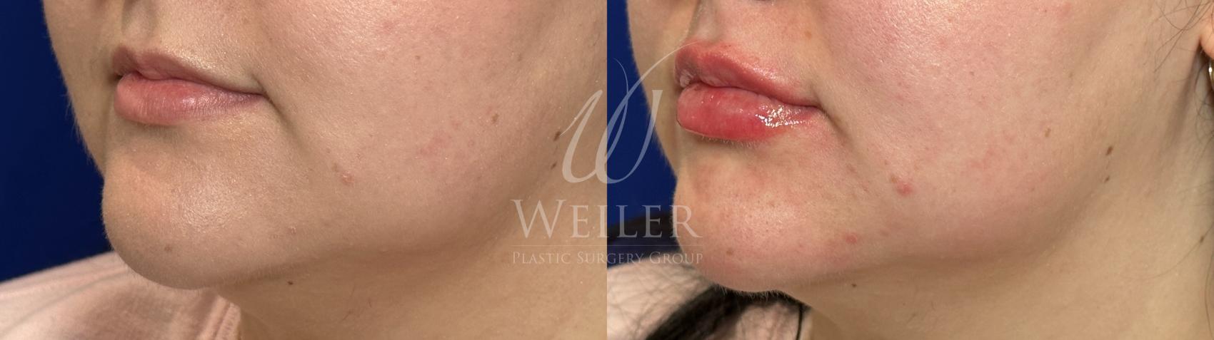 Before & After Lip Augmentation Case 1206 Left Side View in Baton Rouge, New Orleans, & Lafayette, Louisiana