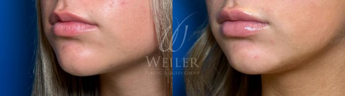 Before & After Lip Augmentation Case 1216 Left Side View in Baton Rouge, New Orleans, & Lafayette, Louisiana