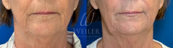 Before & After Lip Augmentation Case 1217 Front View in Baton Rouge, Louisiana