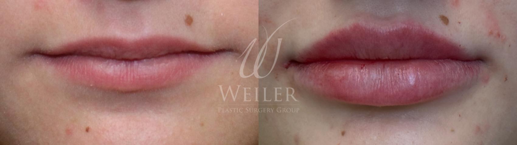 Before & After Lip Augmentation Case 1244 Front View in Baton Rouge, New Orleans, & Lafayette, Louisiana