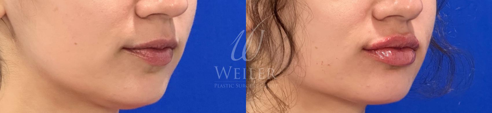 Before & After Lip Augmentation Case 1260 Right Oblique View in Baton Rouge, New Orleans, & Lafayette, Louisiana