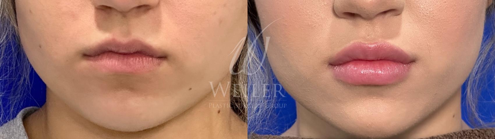 Before & After Lip Augmentation Case 1264 Front View in Baton Rouge, New Orleans, & Lafayette, Louisiana