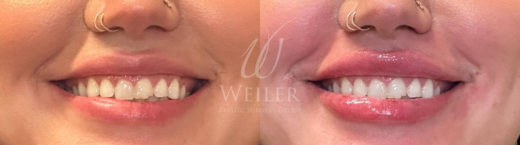 Before & After Lip Augmentation Case 1267 Front View in Baton Rouge, New Orleans, & Lafayette, Louisiana