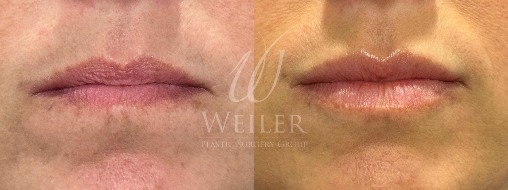 Before & After Lip Augmentation Case 1271 Front View in Baton Rouge, New Orleans, & Lafayette, Louisiana