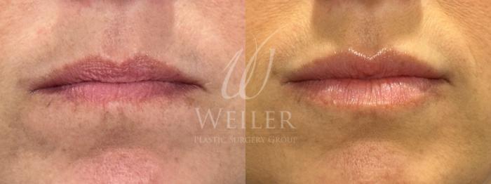 Before & After Lip Augmentation Case 1271 Front View in Baton Rouge, New Orleans, & Lafayette, Louisiana