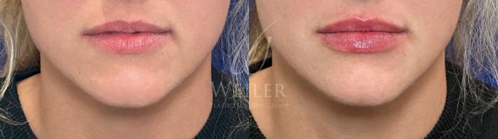 Before & After Lip Augmentation Case 1295 Front View in Baton Rouge, New Orleans, & Lafayette, Louisiana