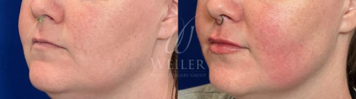 Before & After Lip Augmentation Case 1308 Left Side View in Baton Rouge, New Orleans, & Lafayette, Louisiana