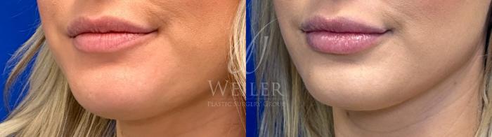 Before & After Lip Augmentation Case 1323 Left Side View in Baton Rouge, New Orleans, & Lafayette, Louisiana