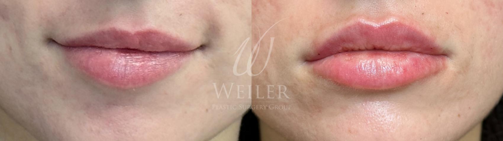 Before & After Lip Augmentation Case 1344 Front View in Baton Rouge, New Orleans, & Lafayette, Louisiana