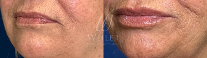 Before & After Lip Augmentation Case 1374 Left Side View in Baton Rouge, New Orleans, & Lafayette, Louisiana