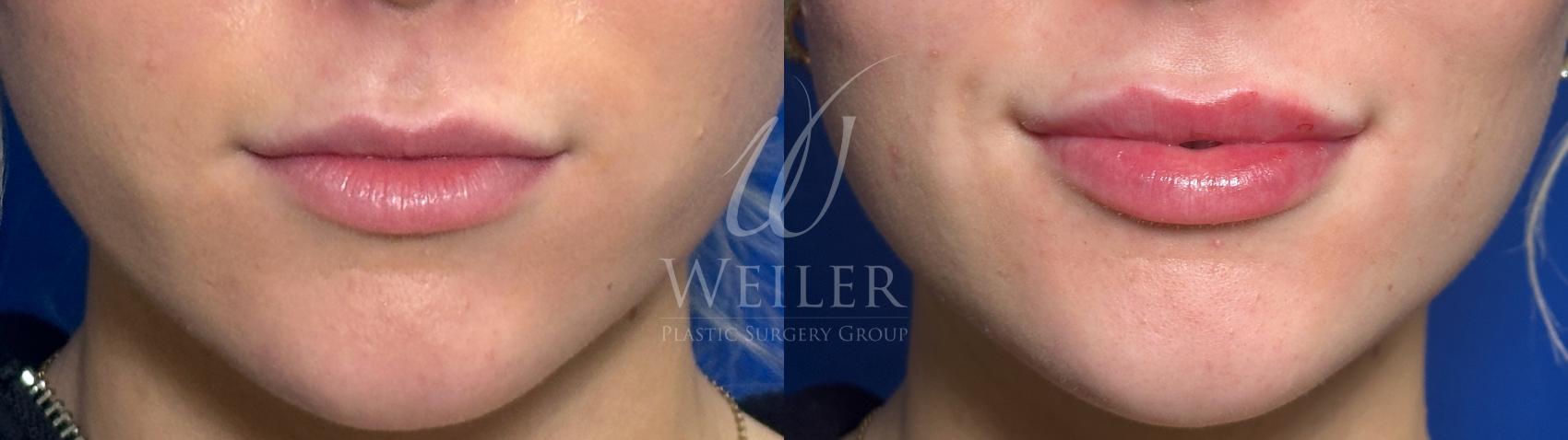 Before & After Lip Augmentation Case 1416 Front View in Baton Rouge, New Orleans, & Lafayette, Louisiana