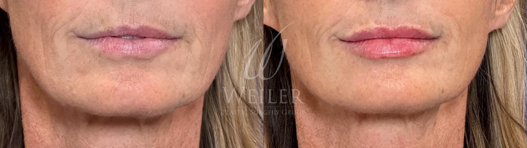 Before & After Lip Augmentation Case 1438 Front View in Baton Rouge, New Orleans, & Lafayette, Louisiana