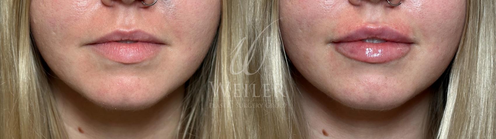 Before & After Lip Augmentation Case 1450 Front View in Baton Rouge, New Orleans, & Lafayette, Louisiana